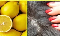 How to get rid of Dandruff naturally? 